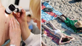 Sve više oboljelih od melanoma
