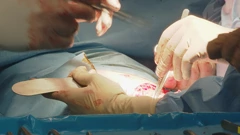  transplantacije