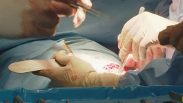  transplantacije