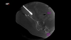 Termalna ablacija, Foto: HTV/HRT