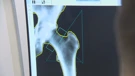 Ilustracija, osteoporoza