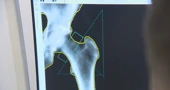 Ilustracija, osteoporoza