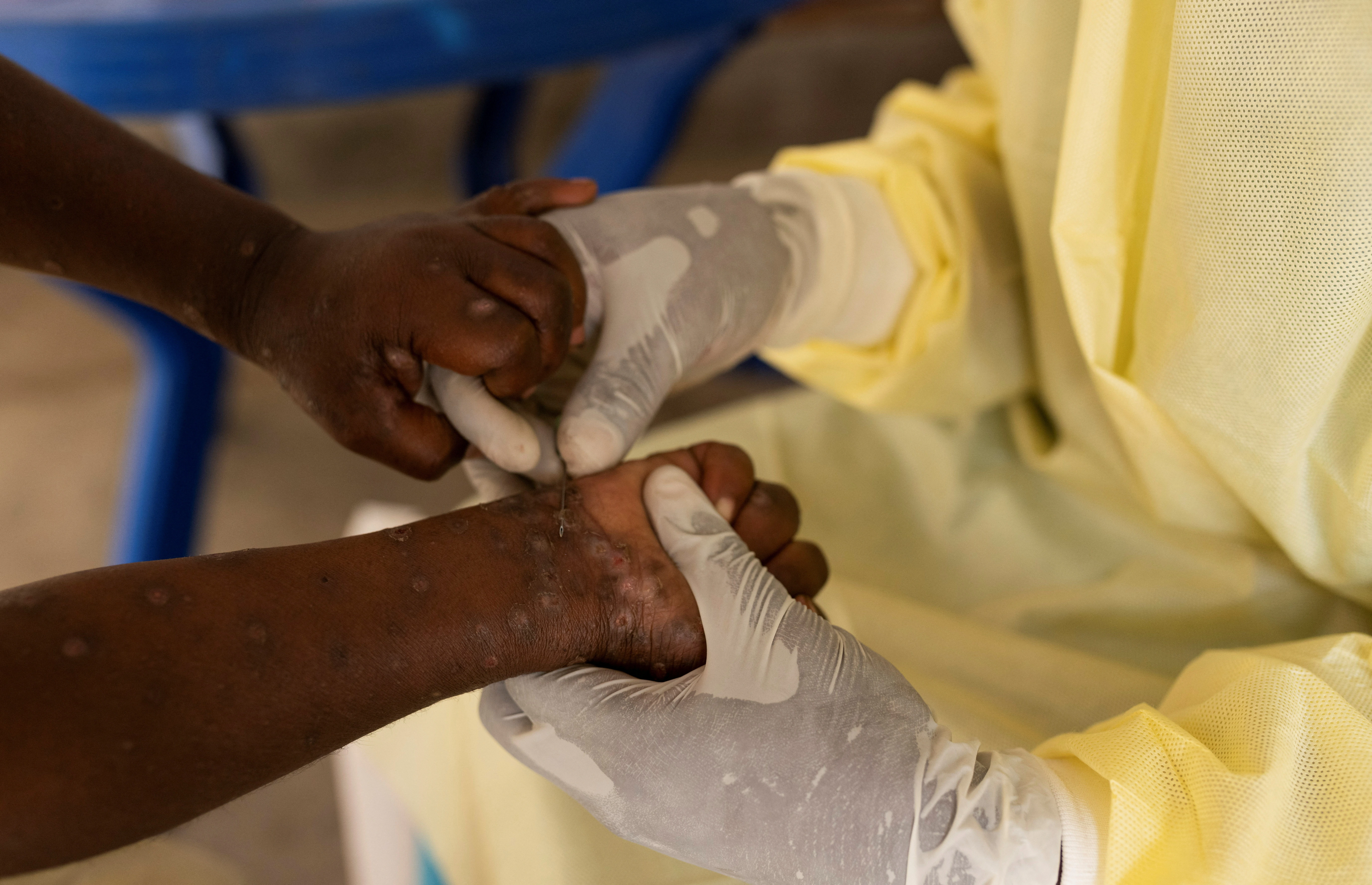 2024 07 24t083648z 1349186653 rc2yx8alilp0 rtrmadp 3 health mpox congo 20240817061312