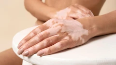 Vitiligo je kronična bolest kože obilježena pojavom bjelkastih mrlja na koži i na sluznicama