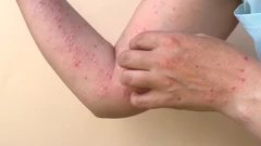 U Švedskoj prvi slučaj majmunskih boginja izvan Afrike