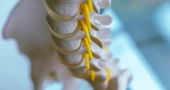 Spina bifida