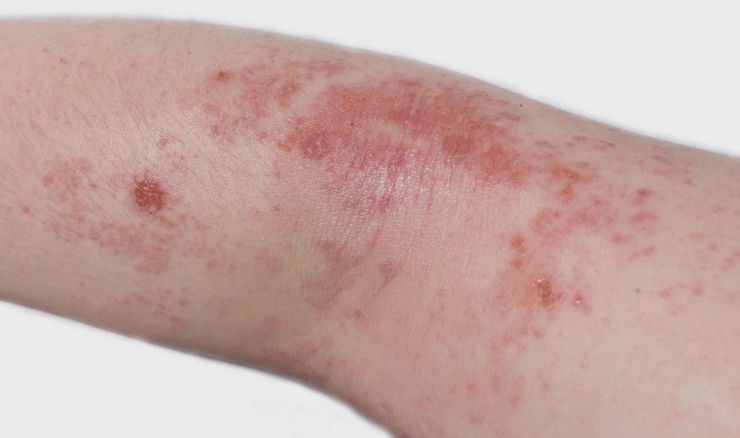 Sve više slučajeva impetiga na Jadranu; kako prepoznati zaraznu infekciju kože