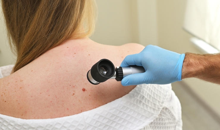 Novo otkriće s IRB-a o kretanju stanica melanoma