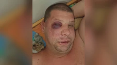 Napadači u Rijeci pretukli mladića s invaliditetom