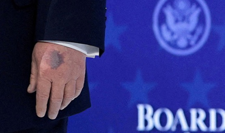 Trump je odličnog zdravlja osim oticanja nogu i modrica na rukama