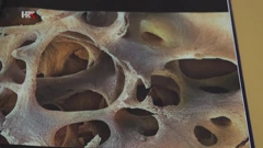 Osteoporoza, ilustracija