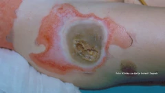 Posljedice nepropisnog rukovanja pirotehnikom, Foto: HTV/HRT