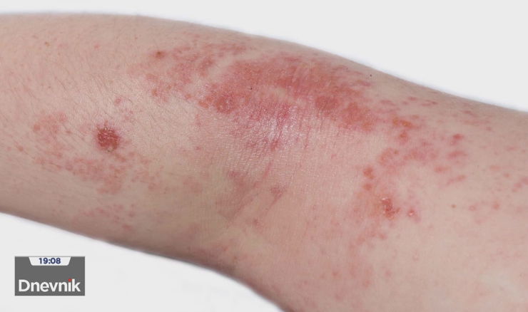 Impetigo je zarazna bakterijska infekcija kože