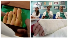 Liječnici KB-a Dubrava mladiću spasili odrezanu šaku