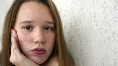 Dijete brzo raste i već ima akne?