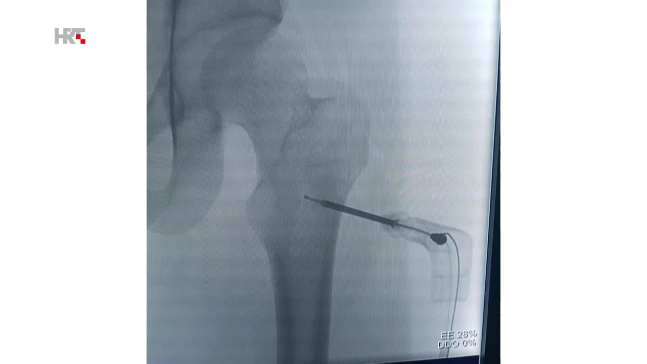 Termalna ablacija, Foto: HTV/HRT